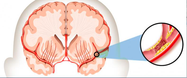 stroke iterwa nuko imjyana yifunze